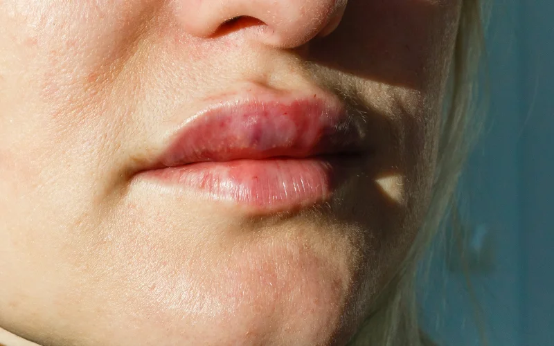 Dấu hiệu tiêm filler bị tràn